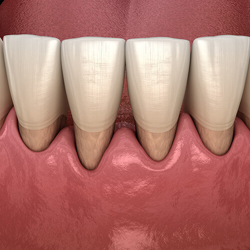 Illustration of denture with gingival receptacle