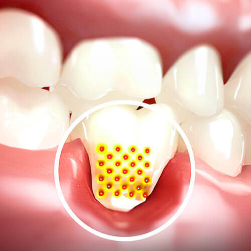 Illustration of denture with gingival receptacle