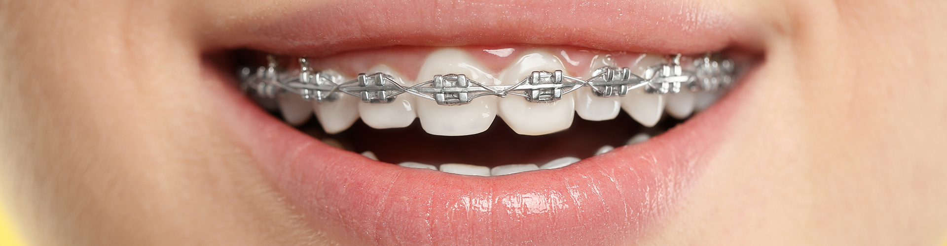 a smile with braces