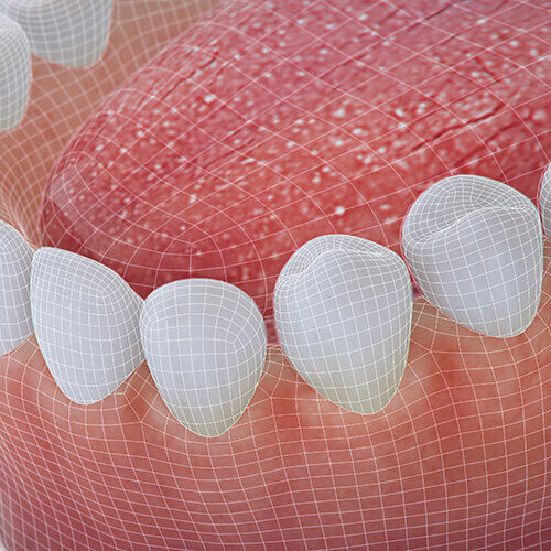Denture illustration