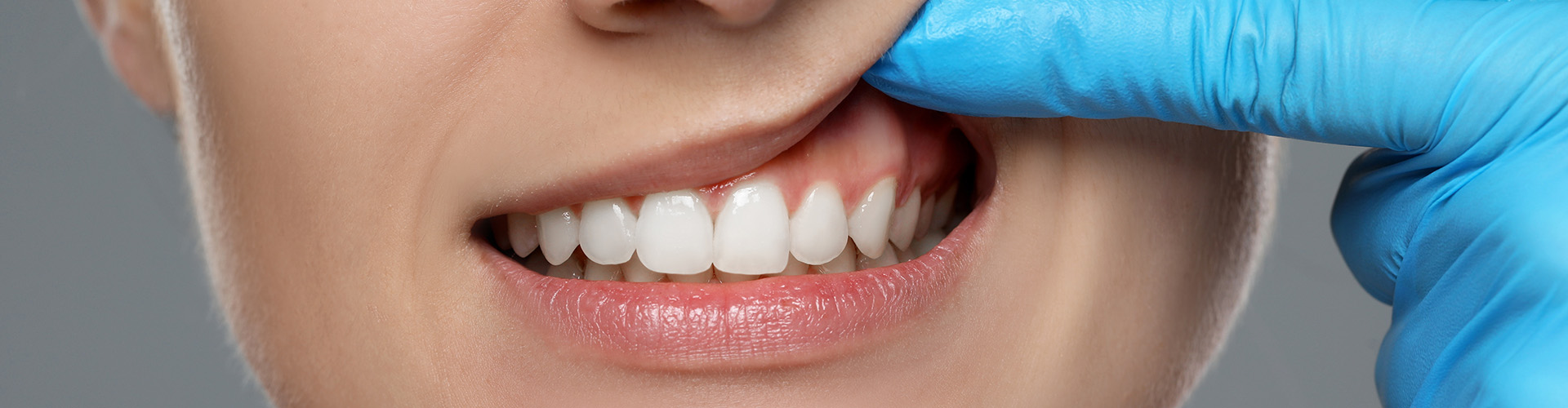 Close-up of a woman showing her teeth, with a blue-gloved finger lifting her upper lip to reveal her gums.