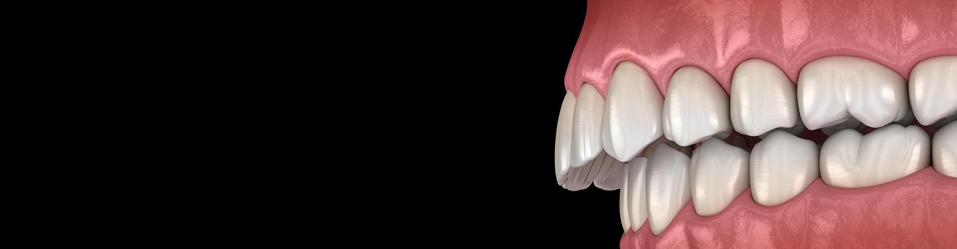Rendering of an overbite.
