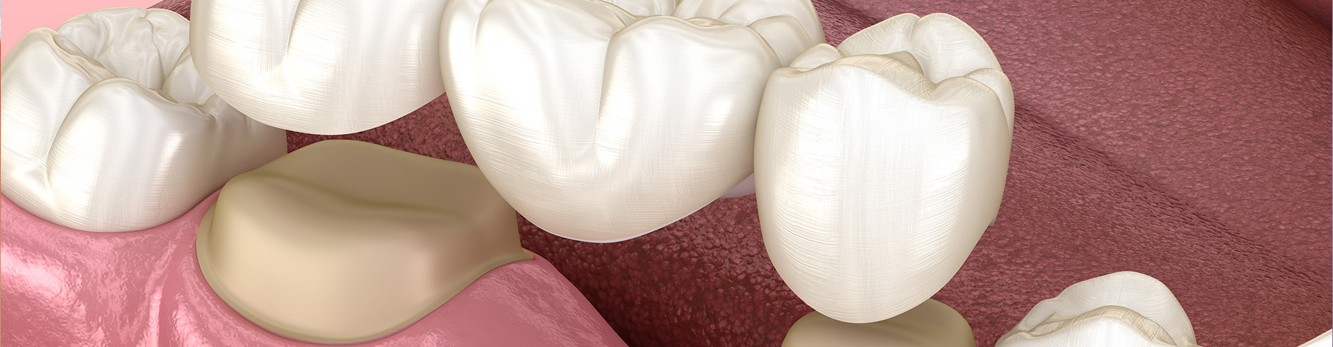 3D render of dental crowns and bridges being placed.
