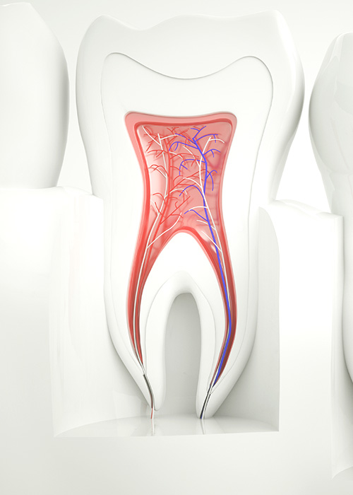 Dental root canal illustration