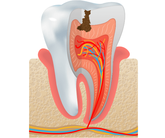 Tooth with cavity illustration